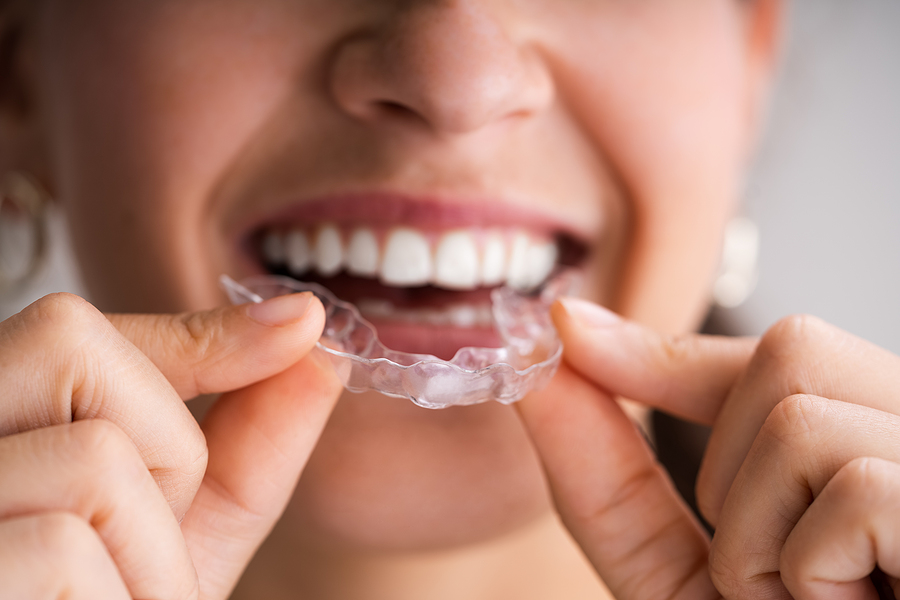 Clear Braces Clear Braces